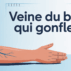 Veine du bras qui gonfle s’inquiéter ou agir rapidement Veine du bras qui gonfle s’inquiéter ou agir rapidement